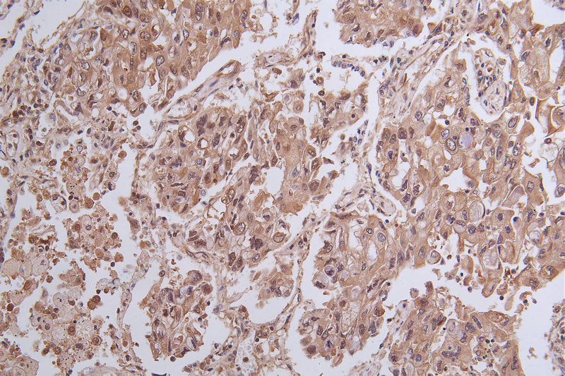 Immunohistochemistry of paraffin-embedded human  lung cancer using the antibody at dilution of 1:100Rabbit anti-Human YWHAG Polyclonal Antibody