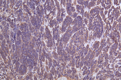 Immunohistochemistry of paraffin-embedded human ovarian cancer using YWHAG Antibody at dilution of 1:100Rabbit anti-Human YWHAG Polyclonal Antibody