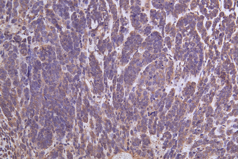 Immunohistochemistry of paraffin-embedded human ovarian cancer using YWHAG Antibody at dilution of 1:100Rabbit anti-Human YWHAG Polyclonal Antibody