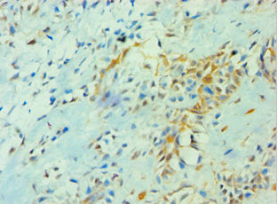 Immunohistochemistry of paraffin-embedded human breast cancer using YWHAQ Antibody at dilution of 1:100Rabbit anti-Human YWHAQ Polyclonal Antibody