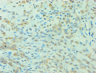 Immunohistochemistry of paraffin-embedded human breast cancer using the antibody at dilution of 1:100Rabbit anti-Human YWHAQ Polyclonal Antibody
