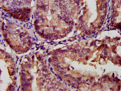 IHC image of LGALS9 Antibody diluted at 1:300 and staining in paraffin-embedded human endometrial cancer performed on a Leica BondTM system. After dewaxing and hydration, antigen retrieval was mediated by high pressure in a citrate buffer (pH 6.0). Section was blocked with 10% normal goat serum 30min at RT. Then primary antibody (1% BSA) was incubated at 4°C overnight. The primary is detected by a biotinylated secondary antibody and visualized using an HRP conjugated SP system.