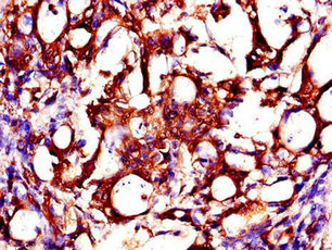 Immunohistochemistry of paraffin-embedded human gastric cancer using ZMPSTE24 Antibody at dilution of 1:100Rabbit anti-Human ZMPSTE24 Polyclonal Antibody