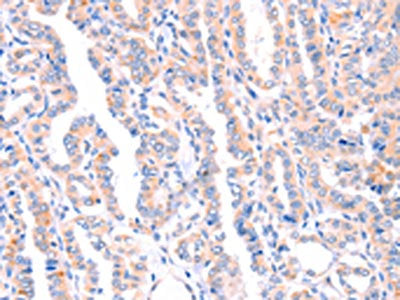 The image on the left is immunohistochemistry of paraffin-embedded Human thyroid cancer tissue using AMPD1 Antibody(AMPD1 Antibody) at dilution 1/70, on the right is treated with synthetic peptide. (Original magnification: ×200)Rabbit anti-Human AMPD1 Polyclonal Antibody