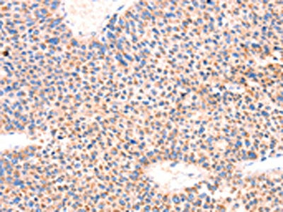 The image on the left is immunohistochemistry of paraffin-embedded Human liver cancer tissue using the antibody Antibody) at dilution 1/70, on the right is treated with synthetic peptide. (Original magnification: ×200)Rabbit anti-Human AMPD1 Polyclonal Antibody