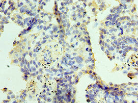 Immunohistochemistry of paraffin-embedded human lung cancer using ZMYND10 Antibody at dilution of 1:100Rabbit anti-Human ZMYND10 Polyclonal Antibody