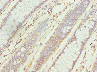 Immunohistochemistry of paraffin-embedded human colon cancer using ZNF169 Antibody at dilution of 1:100Rabbit anti-Human ZNF169 Polyclonal Antibody