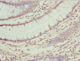Immunohistochemistry of paraffin-embedded human colon cancer using ZNF169 Antibody at dilution of 1:100Rabbit anti-Human ZNF169 Polyclonal Antibody