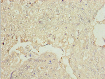 Immunohistochemistry of paraffin-embedded human lung cancer using ZSCAN26 Antibody at dilution of 1:100Rabbit anti-Human ZSCAN26 Polyclonal Antibody