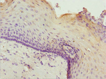 Immunohistochemistry of paraffin-embedded human cervical cancer using ZSCAN26 Antibody at dilution of 1:100Rabbit anti-Human ZSCAN26 Polyclonal Antibody