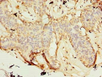 Immunohistochemistry of paraffin-embedded human breast cancer using ZNF19 Antibody at dilution of 1:100