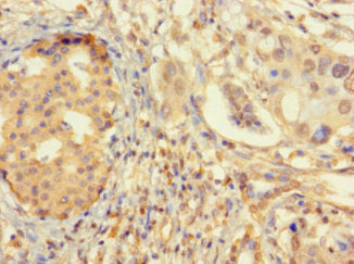 Immunohistochemistry of paraffin-embedded human pancreatic cancer using ZNF2 Antibody at dilution of 1:100Rabbit anti-Human ZNF2 Polyclonal Antibody