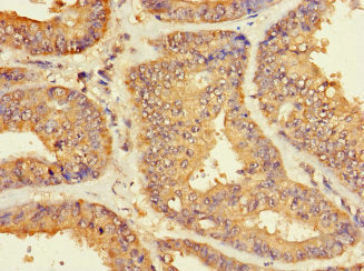 Immunohistochemistry of paraffin-embedded human endometrial cancer using ZNF2 Antibody at dilution of 1:100Rabbit anti-Human ZNF2 Polyclonal Antibody