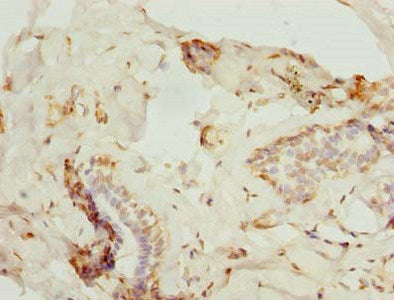 Immunohistochemistry of paraffin-embedded human breast cancer using ZNF232 Antibody at dilution of 1:100Rabbit anti-Human ZNF232 Polyclonal Antibody