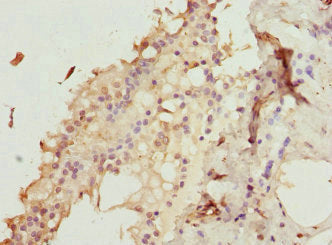 Immunohistochemistry of paraffin-embedded human breast cancer using ZNF24 Antibody at dilution of 1:100Rabbit anti-Human ZNF24 Polyclonal Antibody