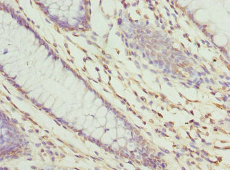 Immunohistochemistry of paraffin-embedded human colon cancer using ZNF324 Antibody at dilution of 1:100Rabbit anti-Human ZNF324 Polyclonal Antibody