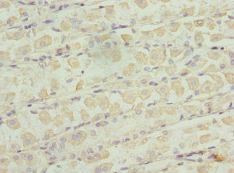 Immunohistochemistry of paraffin-embedded human gastric cancer using ZNF324 Antibody at dilution of 1:100Rabbit anti-Human ZNF324 Polyclonal Antibody