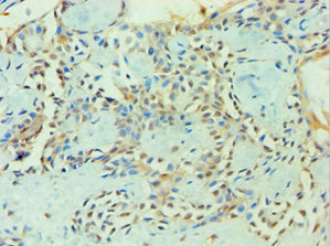 Immunohistochemistry of paraffin-embedded human breast cancer using the antibody at dilution of 1:100Rabbit anti-Human ZNF346 Polyclonal Antibody