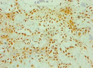 Immunohistochemistry of paraffin-embedded human breast cancer using ZNF346 Antibody at dilution of 1:100Rabbit anti-Human ZNF346 Polyclonal Antibody