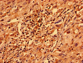 Immunohistochemistry analysis of human lung cancer using ZNF529 Antibody at dilution of 1:100Rabbit anti-Human ZNF529 Polyclonal Antibody