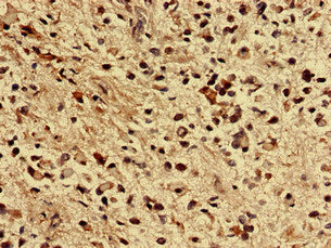 Immunohistochemistry analysis of human glioma using ZNF529 Antibody at dilution of 1:100Rabbit anti-Human ZNF529 Polyclonal Antibody