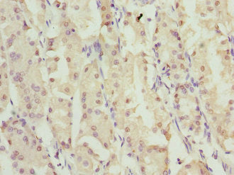 Immunohistochemistry of paraffin-embedded human gastric cancer using ZNF549 Antibody at dilution of 1:100Rabbit anti-Human ZNF549 Polyclonal Antibody