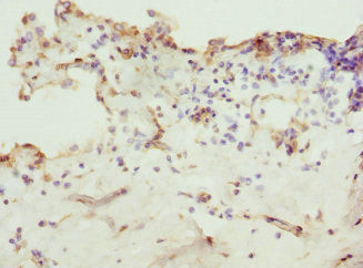 Immunohistochemistry of paraffin-embedded human breast cancer using ZNF549 Antibody at dilution of 1:100Rabbit anti-Human ZNF549 Polyclonal Antibody