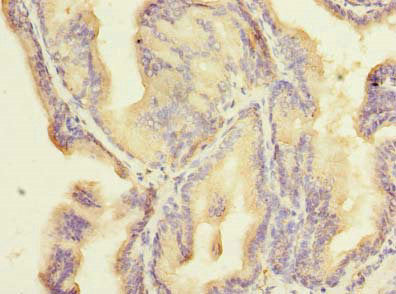 Immunohistochemistry of paraffin-embedded human prostate cancer using ZNF614 Antibody at dilution of 1:100Rabbit anti-Human ZNF614 Polyclonal Antibody