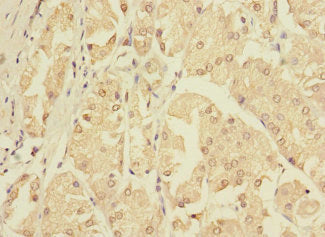 Immunohistochemistry of paraffin-embedded human gastric cancer using ZNF624 Antibody at dilution of 1:100
