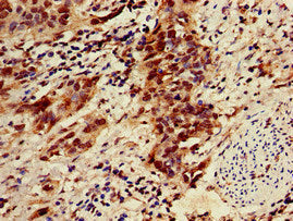 Immunohistochemistry of paraffin-embedded human bladder cancer using ZNF695 Antibody at dilution of 1:100Rabbit anti-Human ZNF695 Polyclonal Antibody