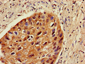 Immunohistochemistry of paraffin-embedded human cervical cancer using ZNF695 Antibody at dilution of 1:100Rabbit anti-Human ZNF695 Polyclonal Antibody