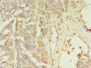Immunohistochemistry of paraffin-embedded human endometrial cancer using ZNF699 Antibody at dilution of 1:100Rabbit anti-Human ZNF699 Polyclonal Antibody