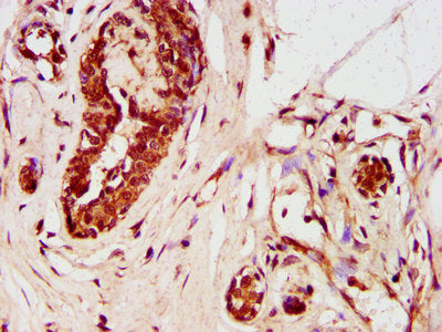 IHC image of ZNF703 Antibody diluted at 1:400 and staining in paraffin-embedded human breast cancer performed on a Leica BondTM system. After dewaxing and hydration, antigen retrieval was mediated by high pressure in a citrate buffer (pH 6.0). Section was blocked with 10% normal goat serum 30min at RT. Then primary antibody (1% BSA) was incubated at 4°C overnight. The primary is detected by a biotinylated secondary antibody and visualized using an HRP conjugated SP system.