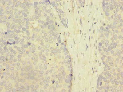 Immunohistochemistry of paraffin-embedded human gastric cancer using ZNF707 Antibody at dilution of 1:100Rabbit anti-Human ZNF707 Polyclonal Antibody