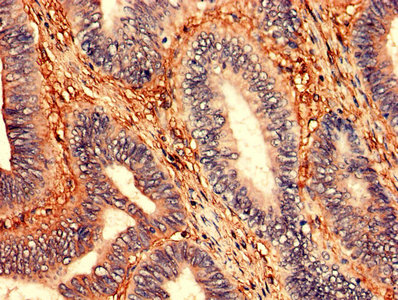 Immunohistochemistry analysis of human colon cancer using ZNF791 Antibody at dilution of 1:100Rabbit anti-Human ZNF791 Polyclonal Antibody