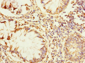 Immunohistochemistry of paraffin-embedded human colon cancer using ZP2 Antibody at dilution of 1:100Rabbit anti-Human ZP2 Polyclonal Antibody