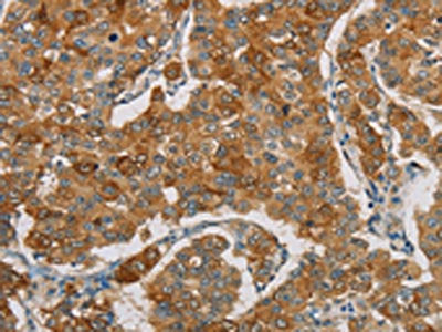 The image on the left is immunohistochemistry of paraffin-embedded Human breast cancer tissue using FOXF2 Antibody(FOXF2 Antibody) at dilution 1/30, on the right is treated with synthetic peptide. (Original magnification: ×200)Rabbit anti-Human FOXF2 Polyclonal Antibody