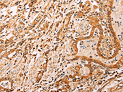 The image on the left is immunohistochemistry of paraffin-embedded Human gastic cancer tissue using ADH1B Antibody(ADH1B Antibody) at dilution 1/40, on the right is treated with synthetic peptide. (Original magnification: ×200)