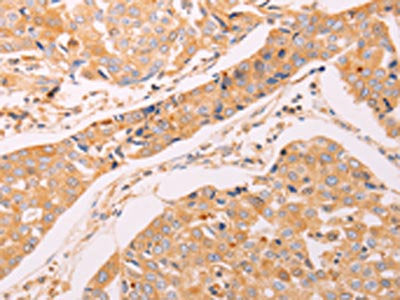 The image on the left is immunohistochemistry of paraffin-embedded Human breast cancer tissue using the antibody Antibody) at dilution 1/40, on the right is treated with synthetic peptide. (Original magnification: ×200)