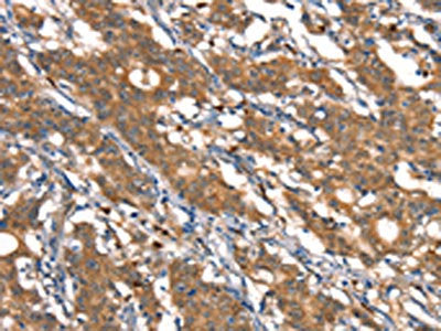 The image on the left is immunohistochemistry of paraffin-embedded Human gastric cancer tissue using CSTB Antibody(CSTB Antibody) at dilution 1/30, on the right is treated with synthetic peptide. (Original magnification: ×200)Rabbit anti-Human CSTB Polyclonal Antibody