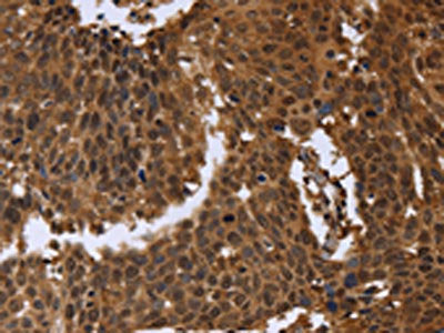 The image on the left is immunohistochemistry of paraffin-embedded Human cervical cancer tissue using FGFRL1 Antibody(FGFRL1 Antibody) at dilution 1/40, on the right is treated with fusion protein. (Original magnification: ×200)Rabbit anti-Human FGFRL1 Polyclonal Antibody