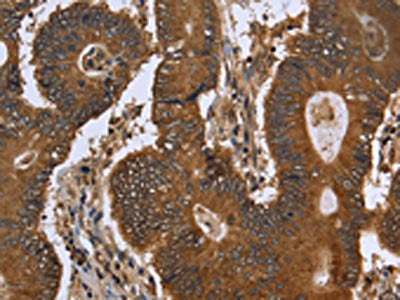 The image on the left is immunohistochemistry of paraffin-embedded Human colon cancer tissue using the antibody Antibody) at dilution 1/40, on the right is treated with fusion protein. (Original magnification: ×200)Rabbit anti-Human FGFRL1 Polyclonal Antibody