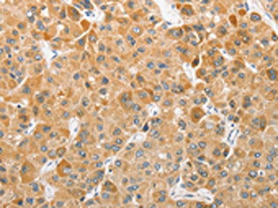 The image on the left is immunohistochemistry of paraffin-embedded Human liver cancer tissue using ATG5 Antibody(ATG5 Antibody) at dilution 1/40, on the right is treated with fusion protein. (Original magnification: ×200)