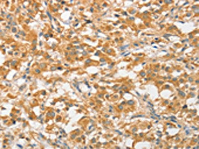 The image on the left is immunohistochemistry of paraffin-embedded Human thyroid cancer tissue using the antibody Antibody) at dilution 1/40, on the right is treated with fusion protein. (Original magnification: ×200)