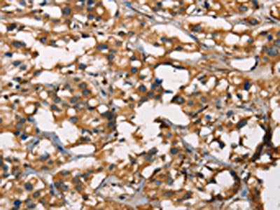 The image on the left is immunohistochemistry of paraffin-embedded Human thyroid cancer tissue using SENP1 Antibody(SENP1 Antibody) at dilution 1/40, on the right is treated with synthetic peptide. (Original magnification: ×200)Rabbit anti-Human SENP1 Polyclonal Antibody