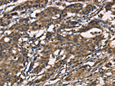 The image on the left is immunohistochemistry of paraffin-embedded Human gastic cancer tissue using the antibody Antibody) at dilution 1/40, on the right is treated with synthetic peptide. (Original magnification: ×200)Rabbit anti-Human SENP1 Polyclonal Antibody