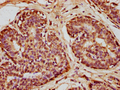 IHC image of SOD1 Antibody diluted at 1:100 and staining in paraffin-embedded human breast cancer performed on a Leica BondTM system. After dewaxing and hydration, antigen retrieval was mediated by high pressure in a citrate buffer (pH 6.0). Section was blocked with 10% normal goat serum 30min at RT. Then primary antibody (1% BSA) was incubated at 4°C overnight. The primary is detected by a biotinylated secondary antibody and visualized using an HRP conjugated SP system.Rabbit anti-Human SOD1 Polyclonal Antibody