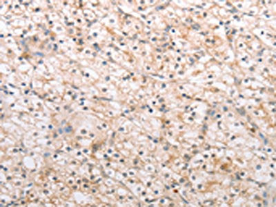 The image on the left is immunohistochemistry of paraffin-embedded Human renal cancer tissue using MMP11 Antibody(MMP11 Antibody) at dilution 1/40, on the right is treated with synthetic peptide. (Original magnification: ×200)