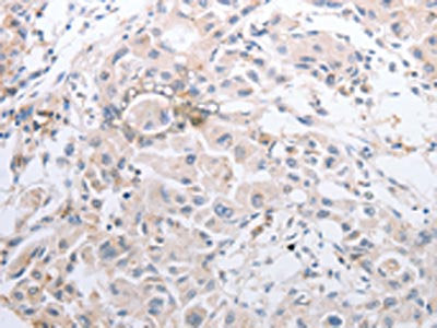 The image on the left is immunohistochemistry of paraffin-embedded Human lung cancer tissue using the antibody Antibody) at dilution 1/40, on the right is treated with synthetic peptide. (Original magnification: ×200)