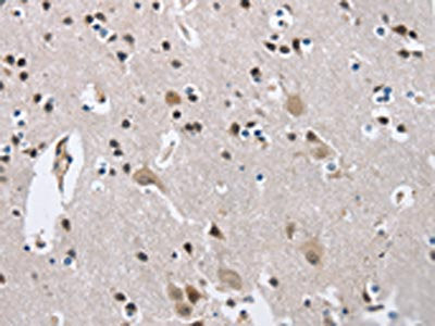 The image on the left is immunohistochemistry of paraffin-embedded Human brain  tissue using MAPT Antibody(MAPT Antibody) at dilution 1/40, on the right is treated with synthetic peptide. (Original magnification: ×200)